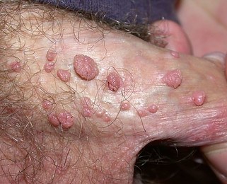 Genital warts