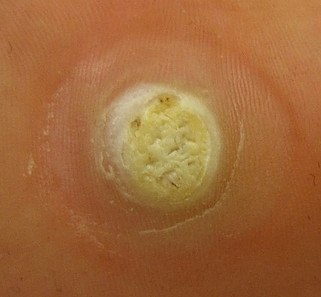 Plantar warts