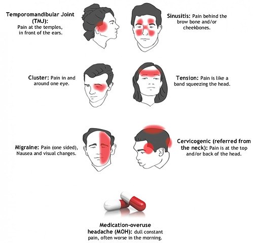 Types of headaches