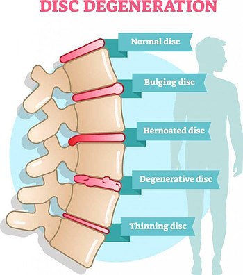 Degenerative Disc Disease